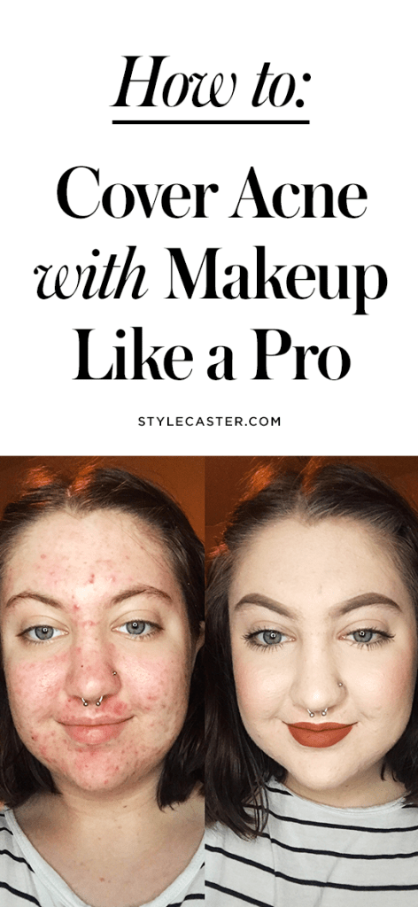How to Cover Acne with Makeup | Before-and-After