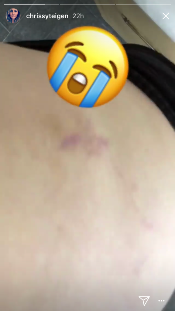 Chrissy Teigen