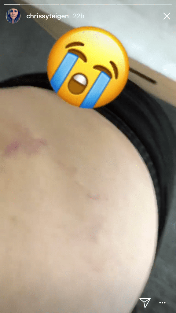 Chrissy Teigen
