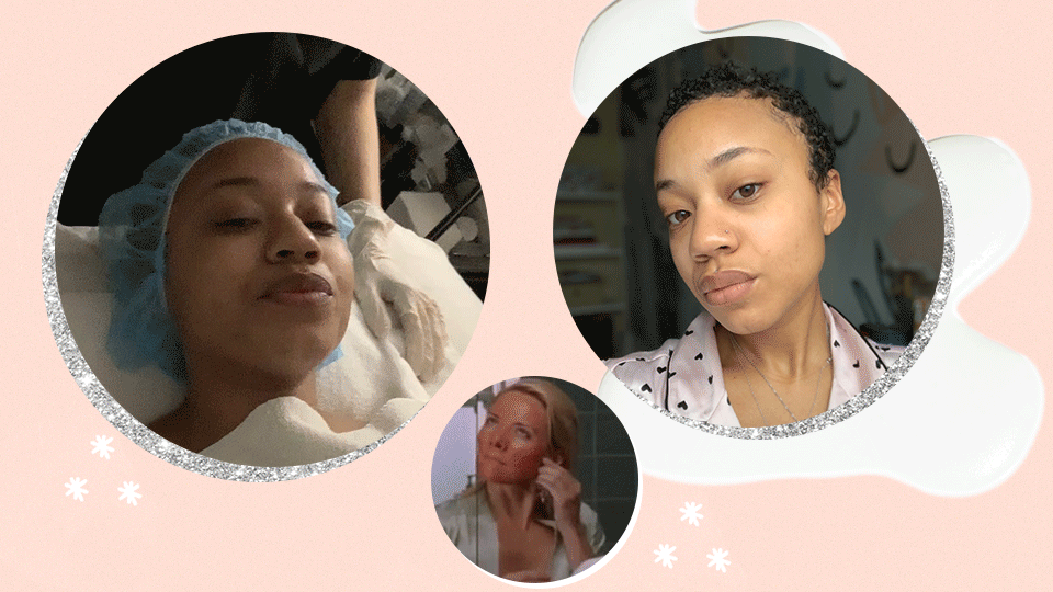 pca-chemical-peel-review